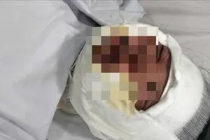 Long An: Nổ bình gas, 9 học sinh và giáo viên bị bỏng 