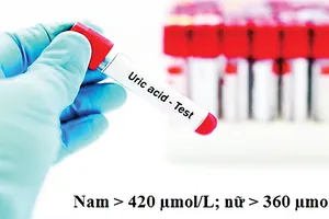 Chỉ số acid uric cao, sưng, đau do Gút làm thế nào để bớt tái phát?