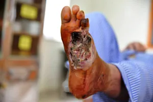 Một bệnh nhân  đái tháo đường  bị biến chứng bàn chân tăng nặng
