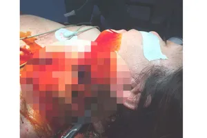 Cứu sống vợ chồng bị cứa cổ nguy kịch