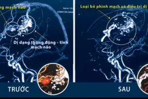 Ảnh chụp CT trước và sau khi phẫu thuật