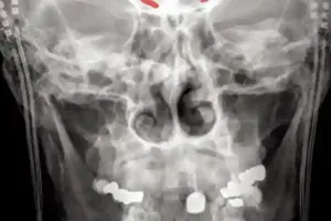 Não tiết lộ mức độ các cơn đau mãn tính