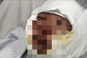 Cà Mau: Nổ bình gas mini khi dùng tiệc tại đám giỗ, nhiều người nhập viện