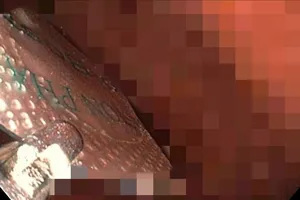 Gắp dị vật là viên thuốc còn nguyên vỏ ra khỏi dạ dày của nam bệnh nhân ở Lâm Đồng