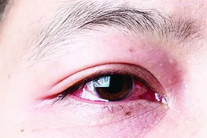 Biểu hiện của bệnh là đỏ mắt, ngứa và sưng mắt