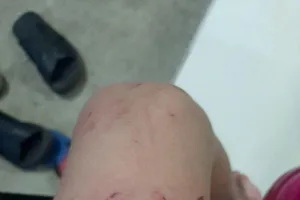 Dấu vết xước do bị khỉ cào 