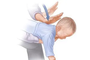 Khi trẻ bị hóc dị vật cần phải được sơ cứu  kịp thời và đúng cách. Ảnh minh họa.