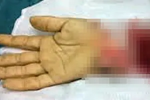 Truy xét nhóm đòi nợ chém gần đứt lìa tay người đàn ông ở TPHCM