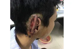 Em T.Đ.T. với vành tai bị cắn đứt