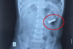 兩歲女孩誤吞３釐米螺絲釘