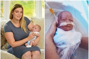 最細早產嬰兒　出世時輕過一罐汽水