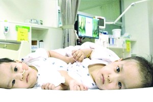 不丹下腹相連雙胞胎手術成功分離