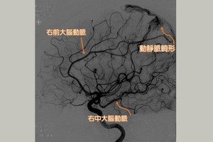 動脈畸形患者因腦內微血管發育不全，腦部動、靜脈交會處有不正常的畸形組織，使動脈直接注入靜脈。