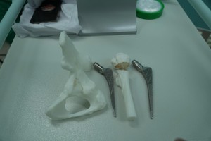 3D printing enables complex hip replacement after 50 years of dysplasia