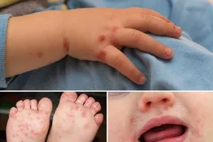 Typical signals of hand-foot-mouth disease (Photo: SGGP)