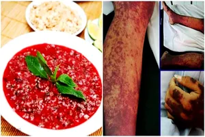 Streptococcus suis claims another life 