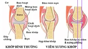 Bệnh xương khớp - không mất tiền oan