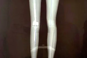 Lần đầu tiên một bệnh nhân đi lại được bằng xương đùi kim loại