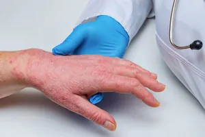 TPHCM: Tăng cường giám sát, phòng chống bệnh đậu mùa khỉ