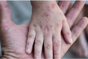 Ban đậu mùa khỉ nổi trên tay của một em nhỏ mắc bệnh ở Israel. Ảnh: REUTERS/TTXVN