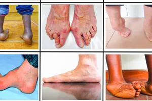 Phẫu thuật miễn phí dị tật cổ bàn chân cho người dân