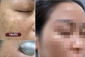 Thực hư chuyện “cải lão hoàn đồng” bằng tia laser