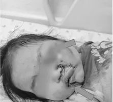 Người lớn bất cẩn, bé gái gặp nạn