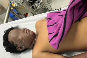 Pháo mua trên mạng phát nổ làm học sinh 13 tuổi bỏng nặng vùng mặt