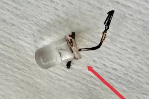 Bác sĩ căng thẳng gắp bóng đèn trong đường thở bé gái 