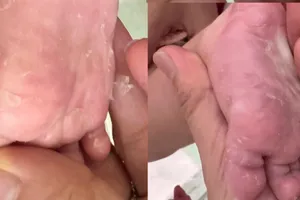 Trẻ nhập viện vì giang mai bẩm sinh, 5 ca biến chứng viêm màng não