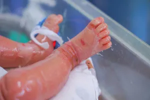 Bé sơ sinh mắc bệnh hiếm gặp, da bong như vảy cá 