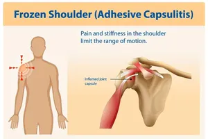 Hành trình phục hồi hội chứng đông cứng khớp vai