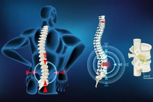 Chuyên gia từ Phòng khám Evolve cho rằng, không phải mọi cơn đau đều bắt nguồn từ đĩa đệm