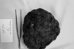 Đang du học tại Đức, nữ sinh về Việt Nam điều trị khối u vú khổng lồ