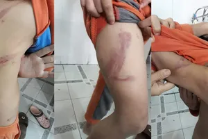 Cháu H.N.N. bị cha ruột đánh 