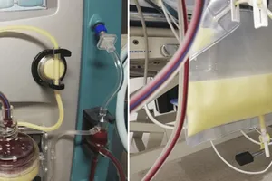 Cứu kịp thời một bệnh nhân viêm tụy cấp, huyết tương có màu đục như sữa