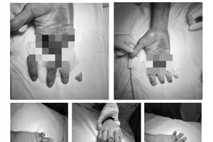 手指断离及经医生手术再植后的图片。