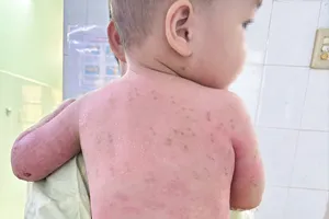 Cơ thể bé B.P.T trước ngày xuất viện. Kỹ thuật ghép da đã giúp vết phỏng hồi phục