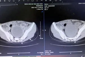 Cứu bé gái 13 tuổi bị dị dạng sinh dục hiếm gặp