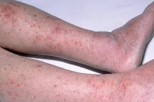 Bệnh não mô cầu có những biểu hiện ban đầu dễ nhầm lẫn với một số bệnh lý khác. Ảnh: TRỊNH HẰNG