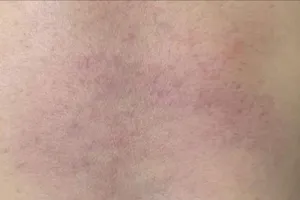 Vết bầm tím trên cơ thể cháu Q. được chia sẻ trên mạng xã hội