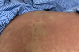 Nguy kịch sau khi dùng thuốc giảm cân thải độc không rõ nguồn gốc