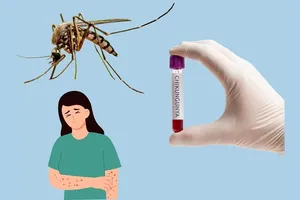 Triệu chứng bệnh Chikungunia xuất hiện sau 4-8 ngày từ khi muỗi Aedes nhiễm bệnh đốt