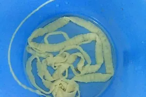 Xổ thành công sán xơ mít dài 6m trong cơ thể người