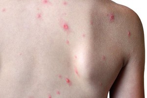 截至本月21日，12國家已通報出現92例猴痘確診病例及28例疑似病例。