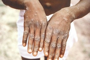 猴痘患者會長皮疹。