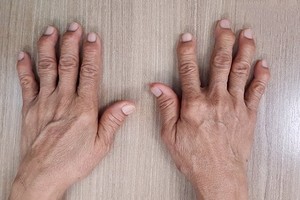 早上痛醒要注意這個病