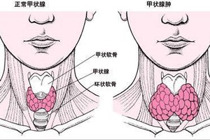 甲亢病人愛在夏天紮堆
