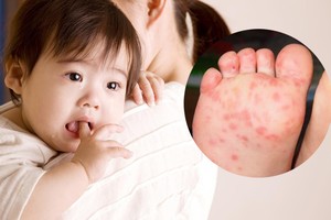 進入新學年，手口足疾病將呈增加趨勢。