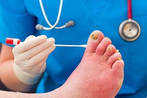 快學如何預防灰指甲